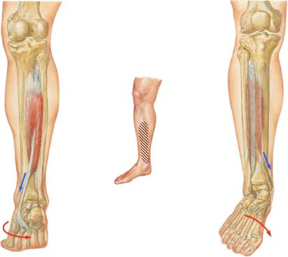 periostitis tibial
